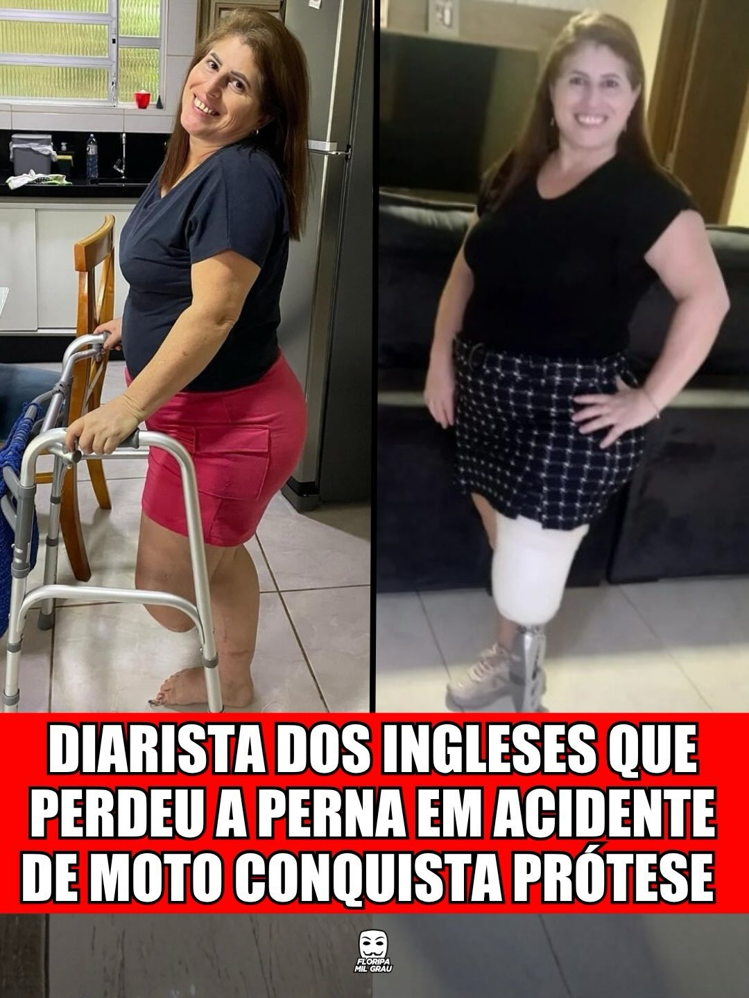 DIARISTA DOS INGLESES QUE PERDEU A PERNA EM ACIDENTE DE MOTO CONQUISTA PRÓTESE