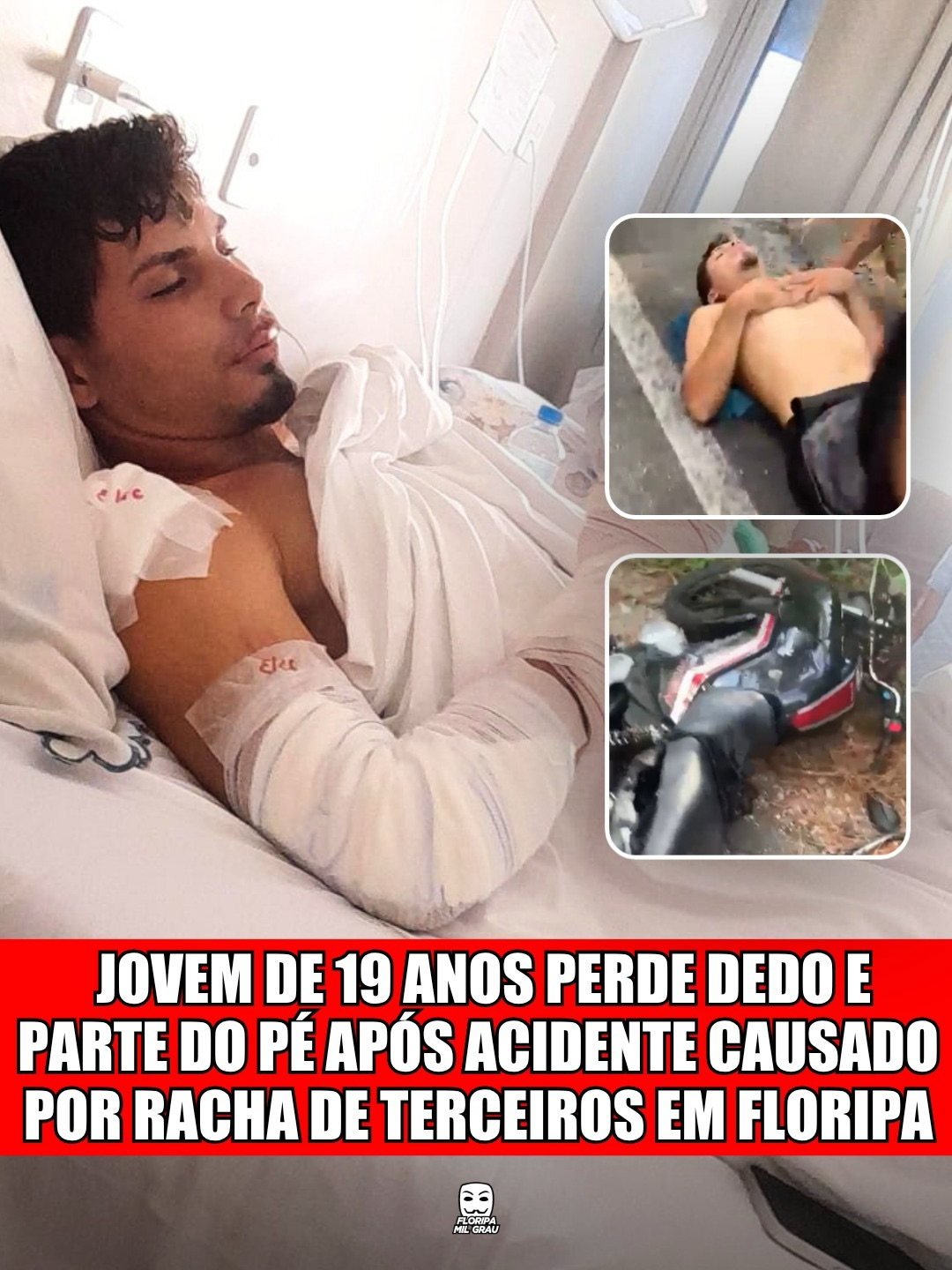 JOVEM DE 19 ANOS PERDE DEDO E PARTE DO PÉ APÓS ACIDENTE CAUSADO POR RACHA DE TERCEIROS EM FLORIPA