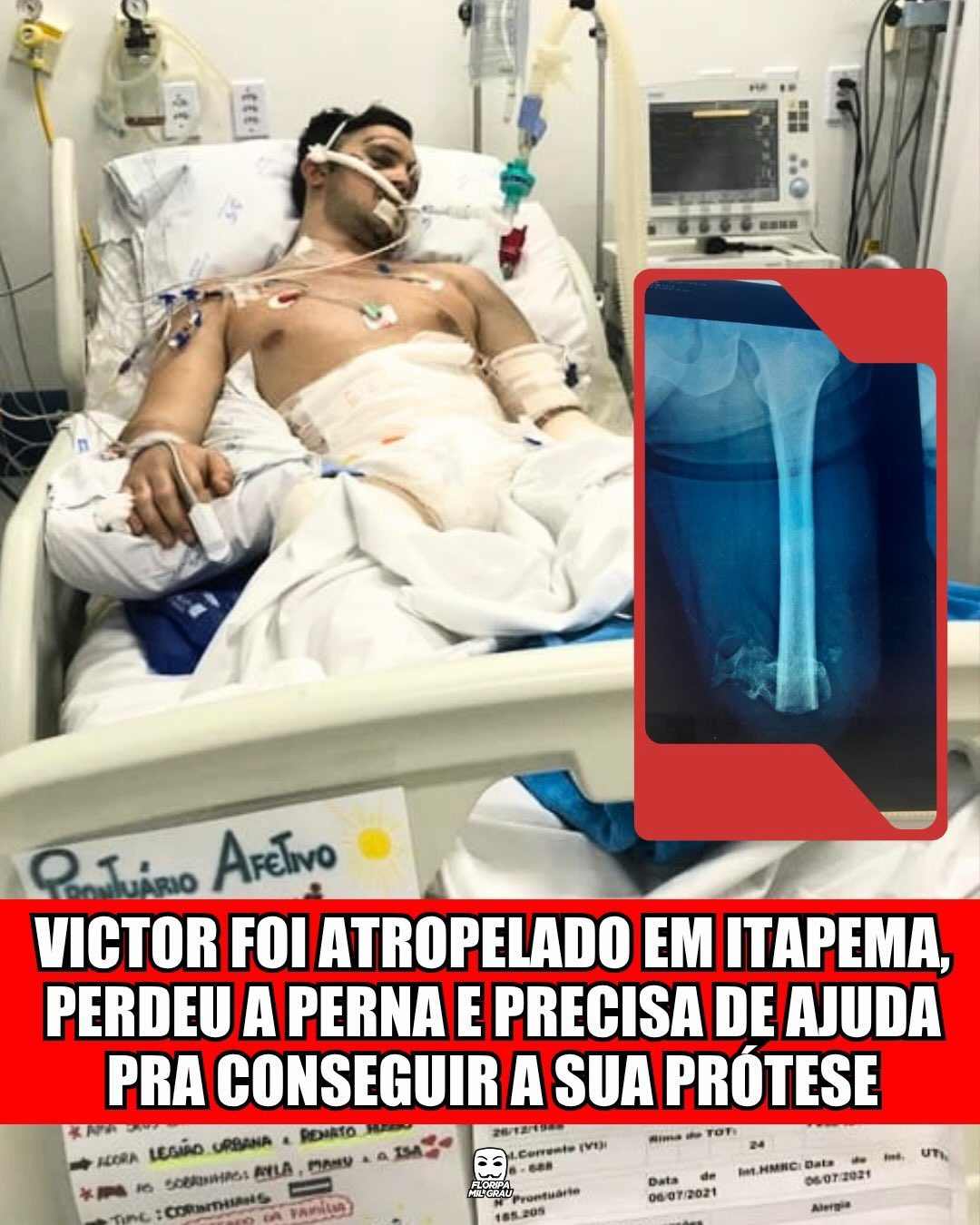 VICTOR FOI ATROPELADO EM ITAPEMA, PERDEU A PERNA E PRECISA DE AJUDA PRA CONSEGUIR A SUA PRÓTESE