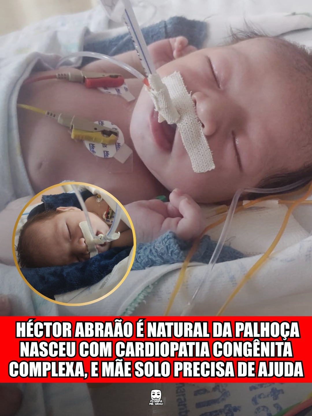 HÉCTOR ABRAÃO É NATURAL DA PALHOÇA, NASCEU COM CARDIOPATIA CONGÊNITA COMPLEXA, E MÃE SOLO PRECISA DE AJUDA