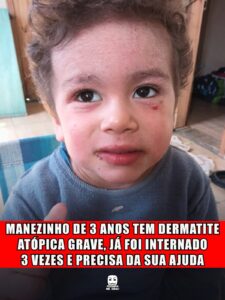 MANEZINHO DE 3 ANOS TEM DERMATITE ATÓPICA GRAVE, JÁ FOI INTERNADO 3 VEZES E PRECISA DA SUA AJUDA