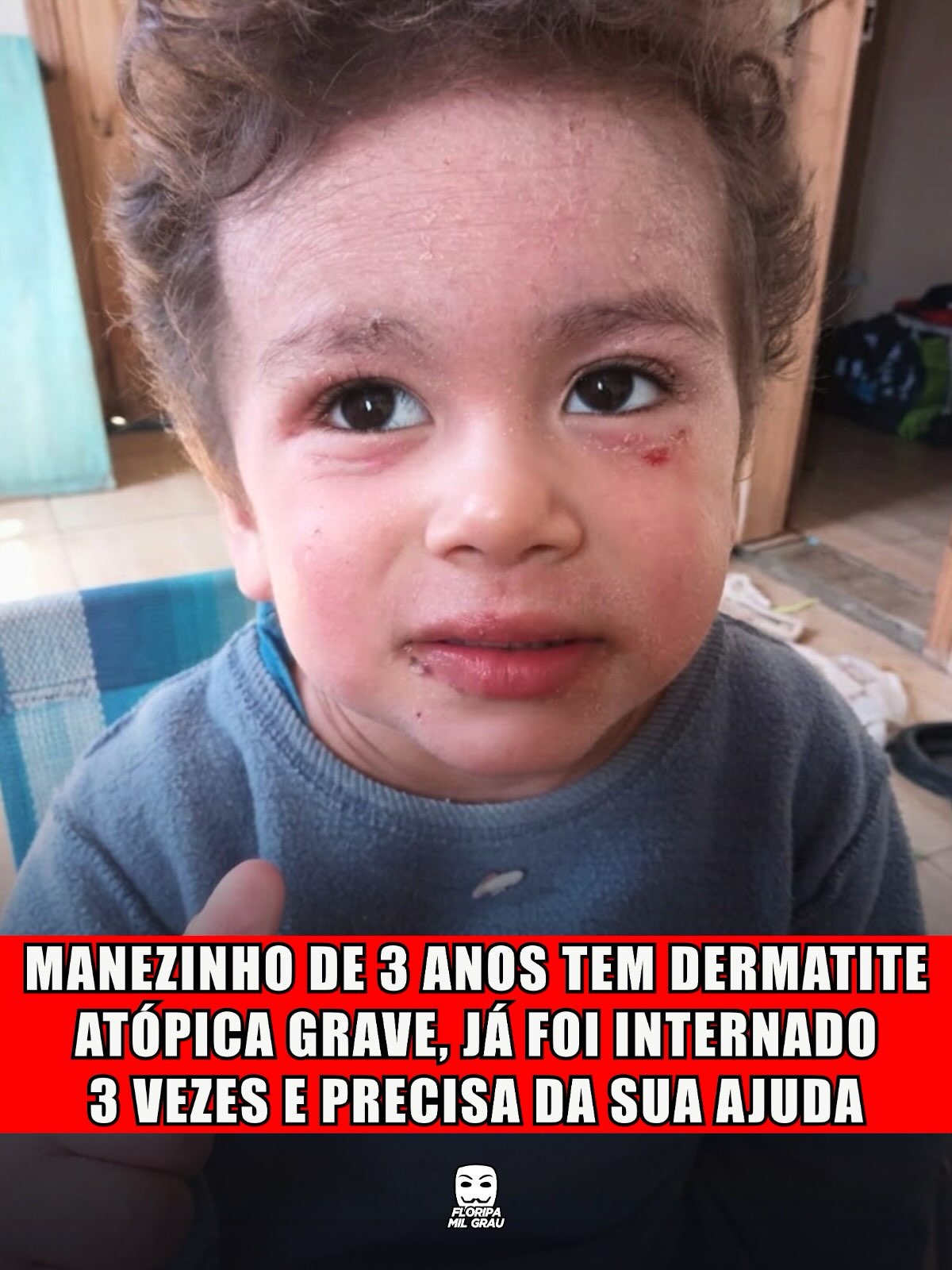 MANEZINHO DE 3 ANOS TEM DERMATITE ATÓPICA GRAVE, JÁ FOI INTERNADO 3 VEZES E PRECISA DA SUA AJUDA